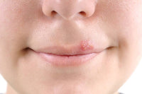 Herpes Labial: Tratamiento Natural para una Piel Radiante y Saludable
