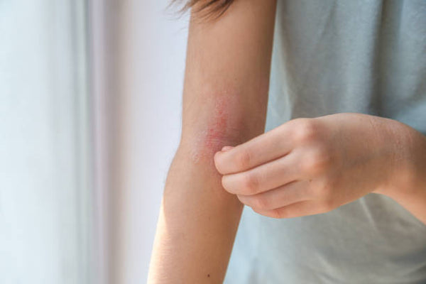 Dermatitis